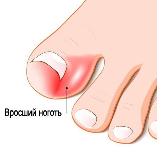 Почему врастает ноготь