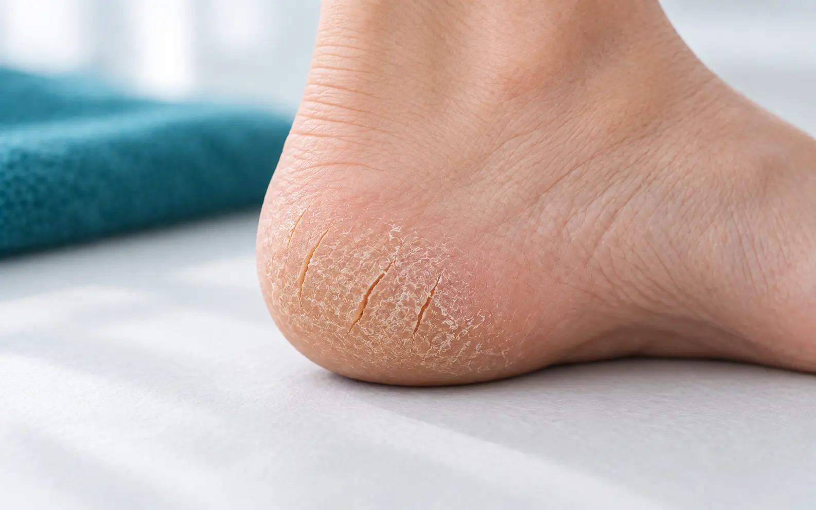 Cracked heels: causes and care